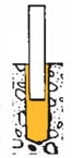 Inserting Reinforcing Bar